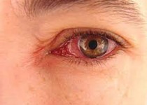 عارضه‌‎هایی که گرما و گردوخاک بر چشم می‌گذارد