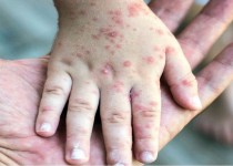 کودکان سیستانی و بلوچستانی بر علیه بیماری سرخک و سرخجه واکسینه می‌‎شوند