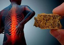 پوکی‌استخوان ارمغان سبک زنگی ناسالم است