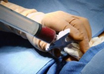 احداث بخش پیوند مغز استخوان در زاهدان