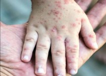 سرخک در کمین است؛ واکسیناسیون را جدی بگیریم