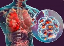 سیستان‌وبلوچستان دارای مقام اول ابتلا به سل